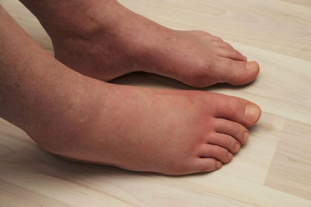 a close up of a patient's swollen feet